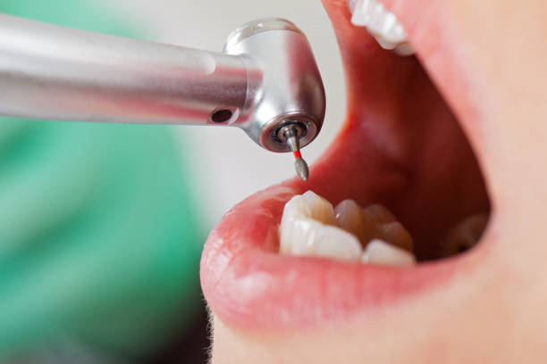 Best Emergency Wisdom Tooth Extraction in Palmview South, TX